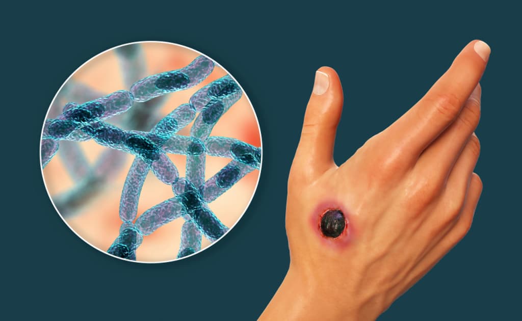 O‘zbekistonda kuydirgi kasalligi xavfi ortib bormoqda